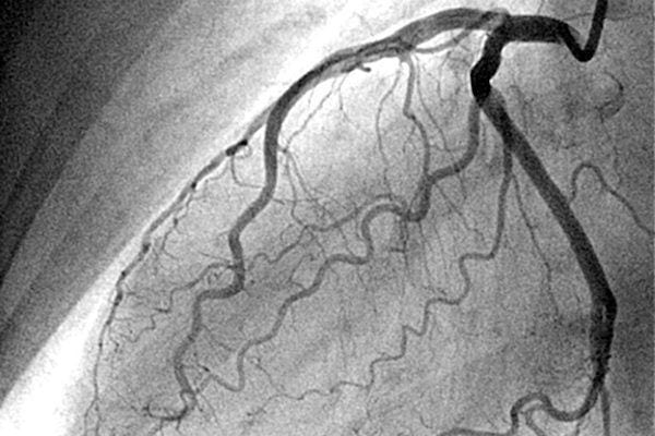 Dr Josue Alejandro Silva Ortiz Cirujano Cardiologo en San Luis Potosi Especialista en Angiografia Coronaria v001 compressor